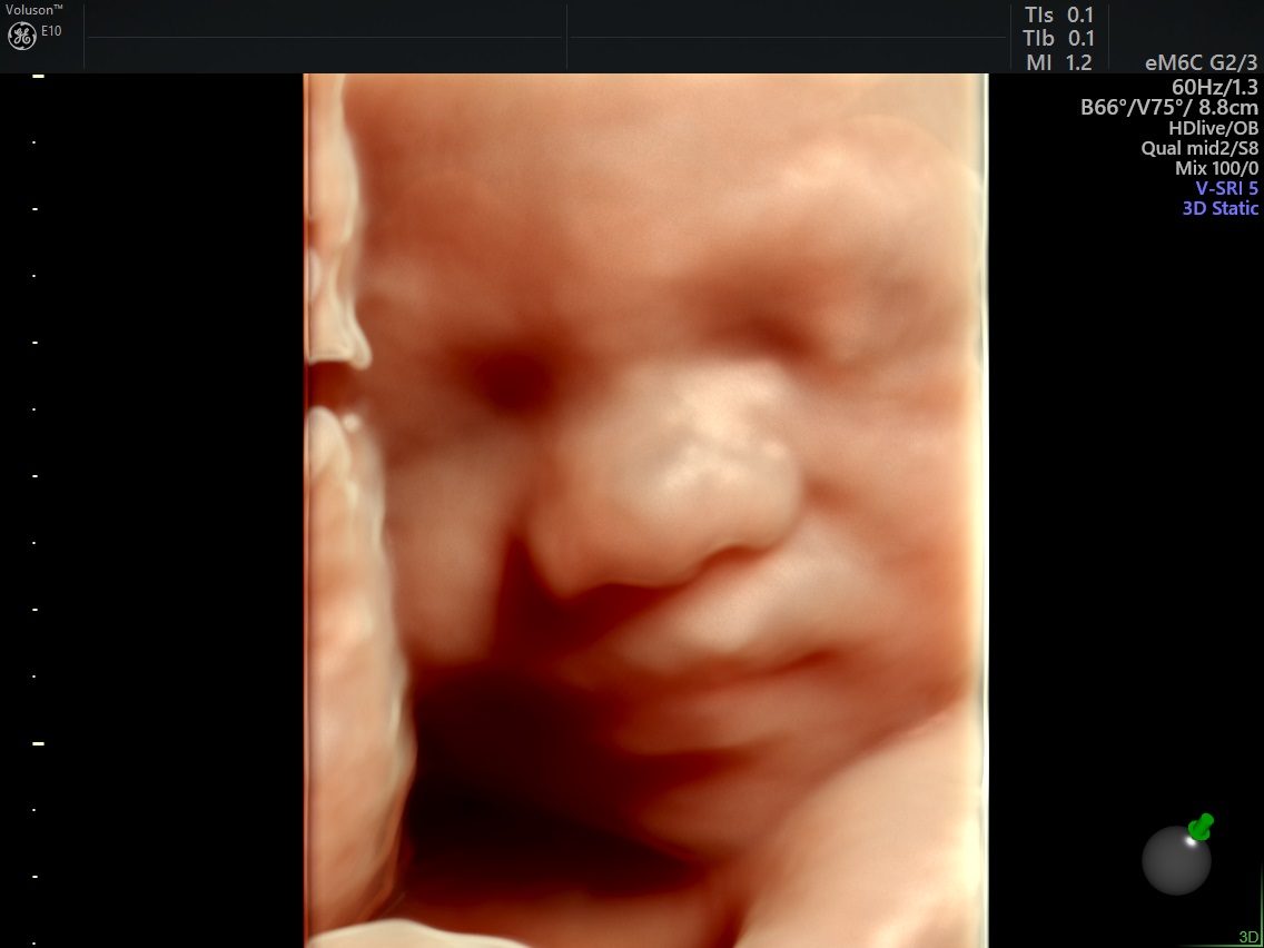 3D ultrasound picture of a baby